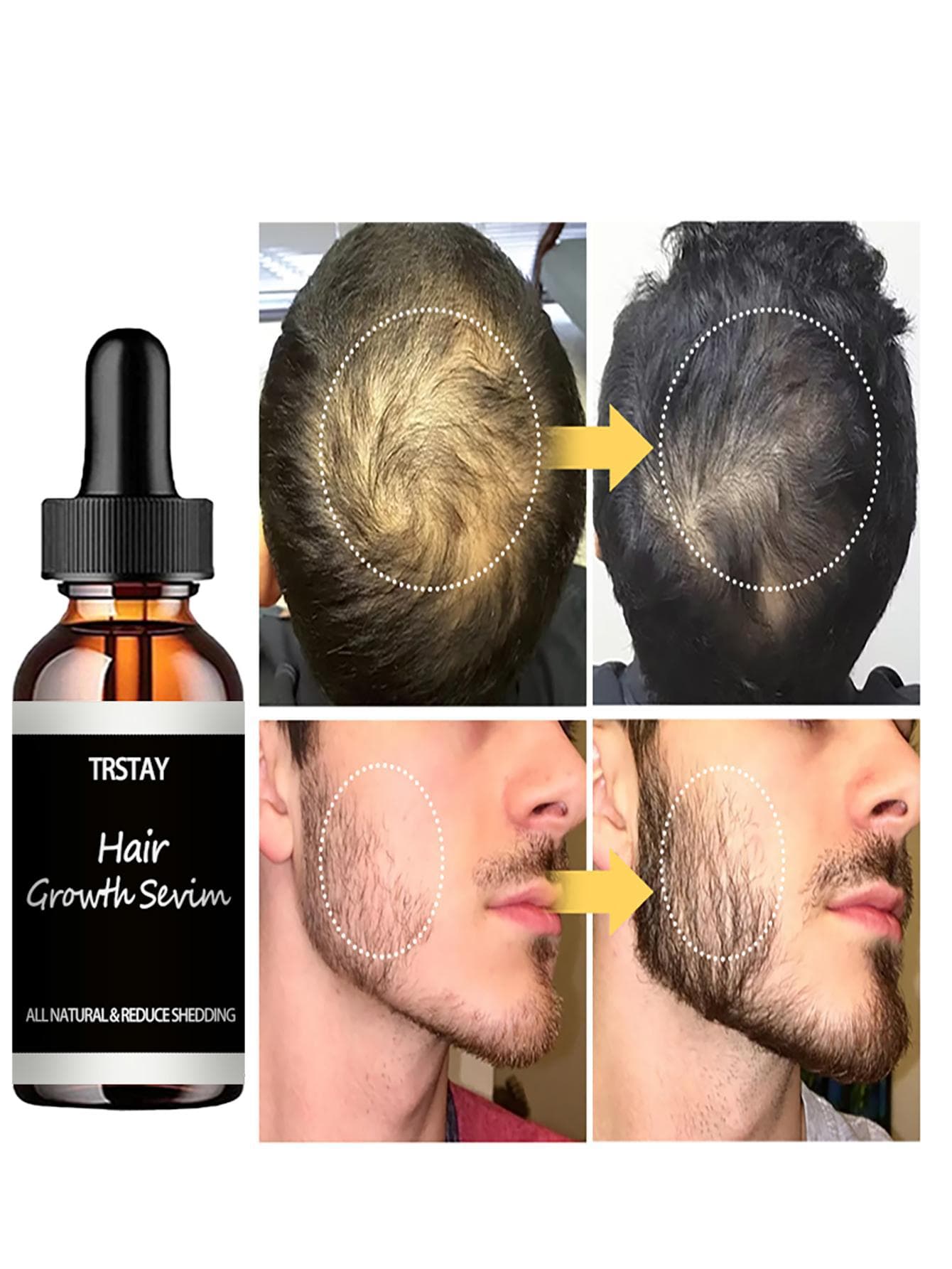 Haarwachstum für Frauen, Minoxidil-5 % Extra Stärke Haarwachstum für Männer